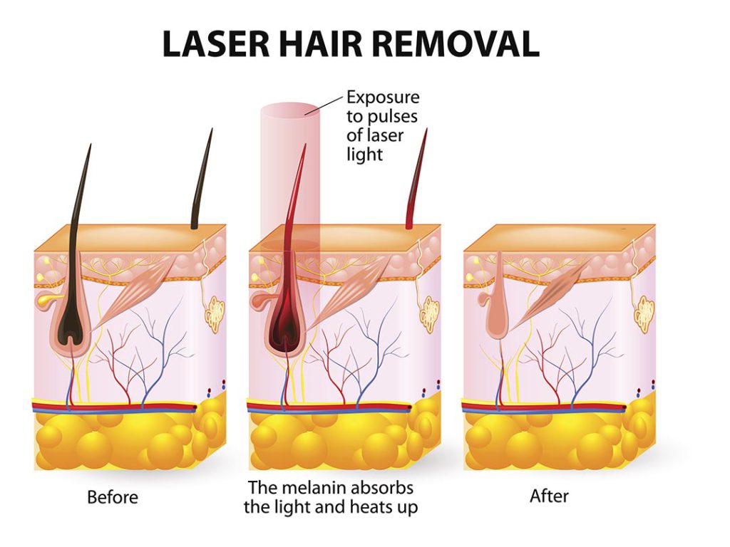 Treat Yourself to Laser Hair Removal This Christmas