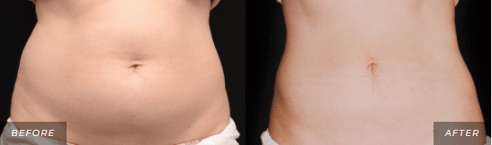 CoolSculpting Treatment Before and After Photos stomach 2
