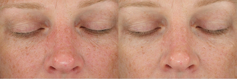 DiamondGlow Treatments Before and After Photos - Before