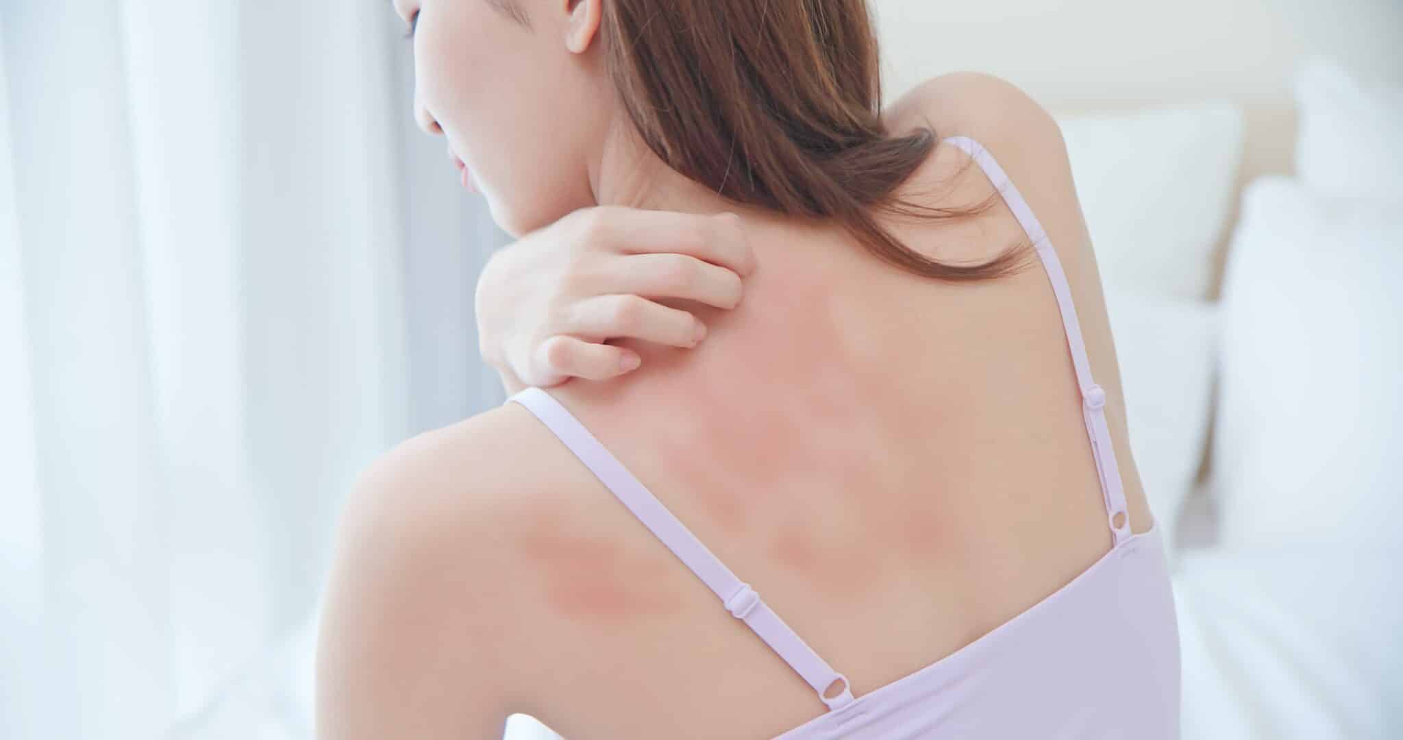 7 Most Common Skin Rashes What They Look Like and How to Treat Them