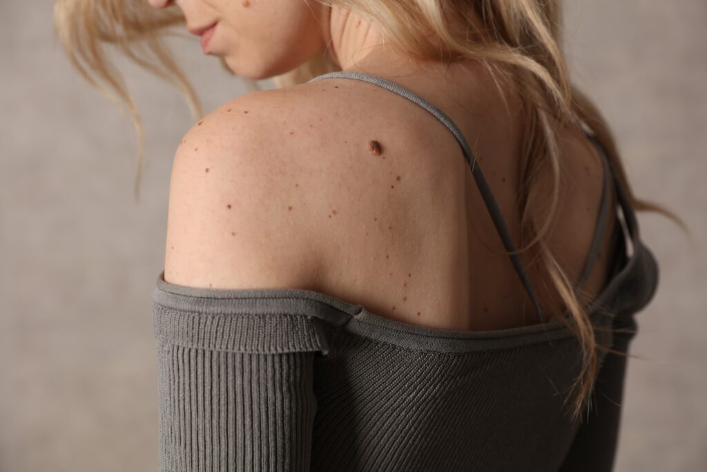 woman looking at the mole on her shoulder