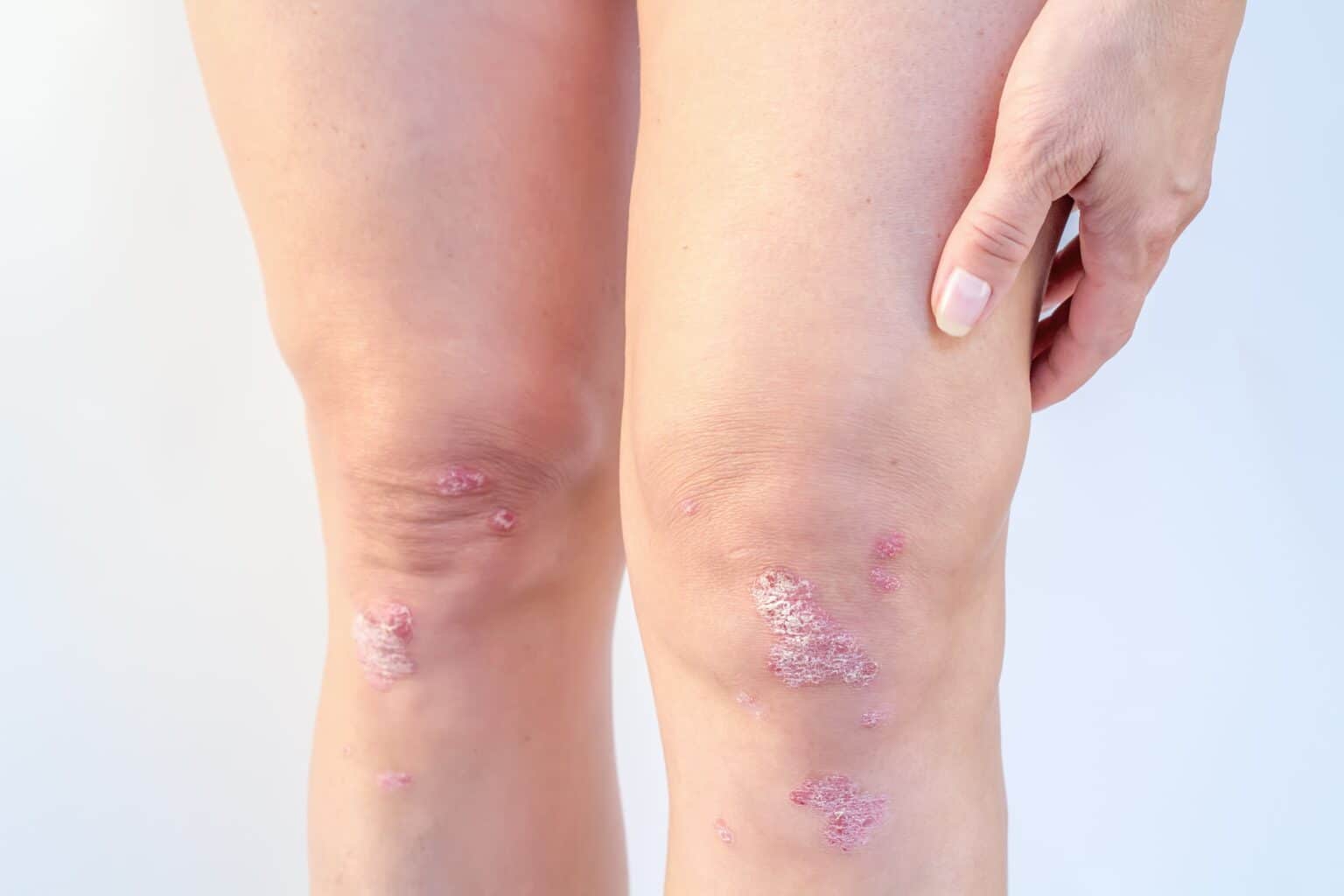 Tips and Tricks to Cope with Psoriasis Skin And Cancer Institute