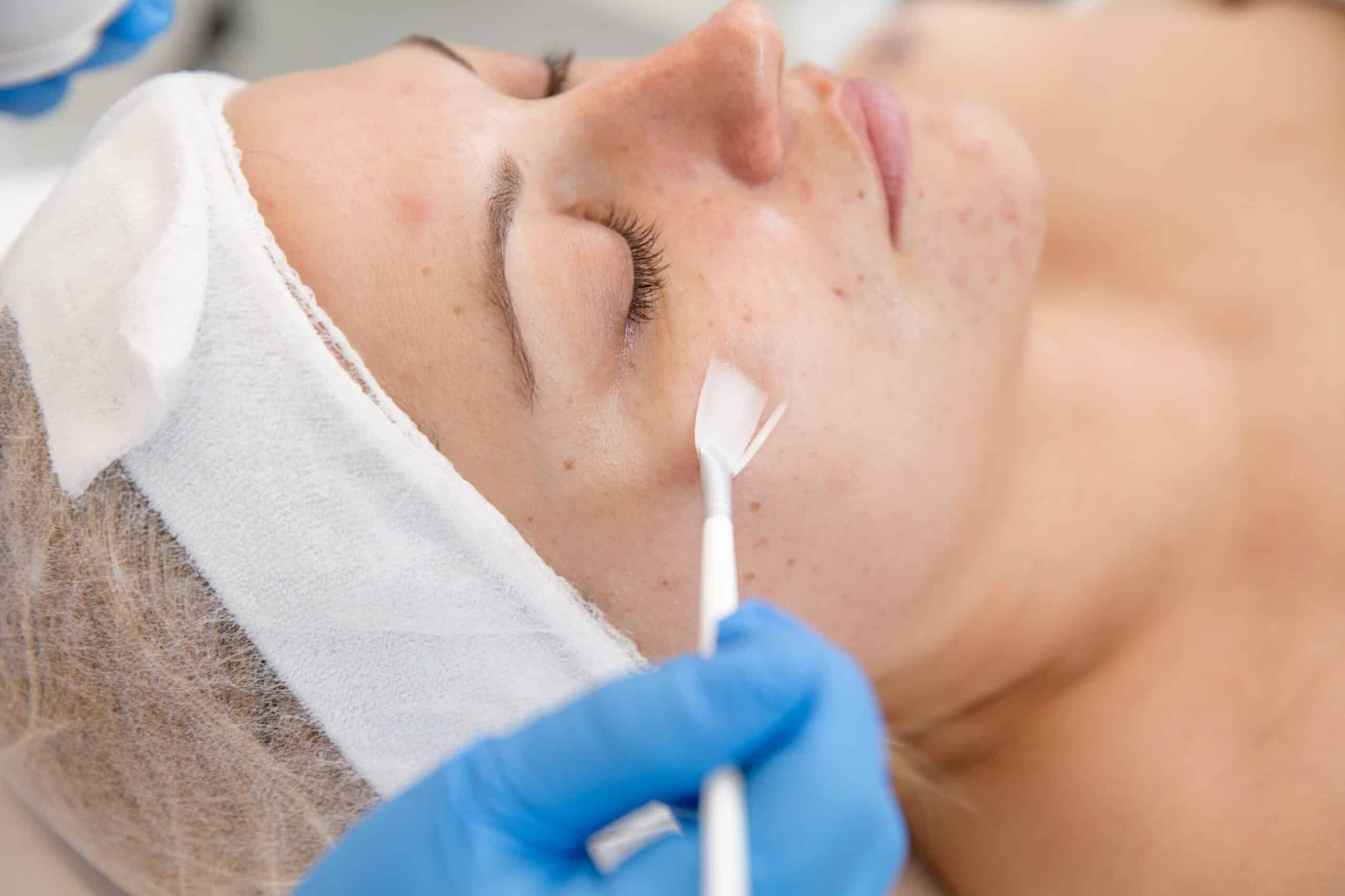Woman receiving chemical peel