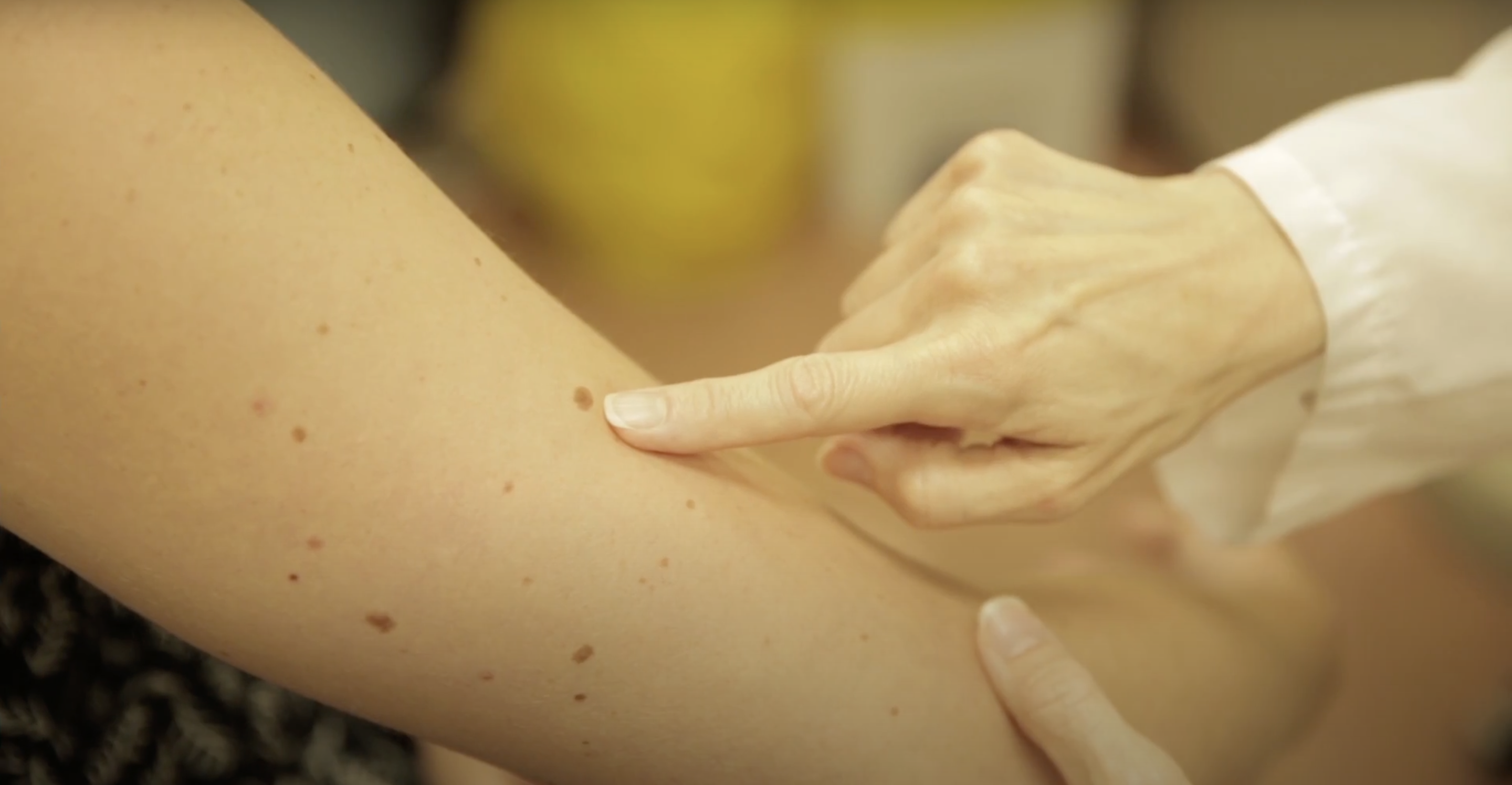 skin cancer risks