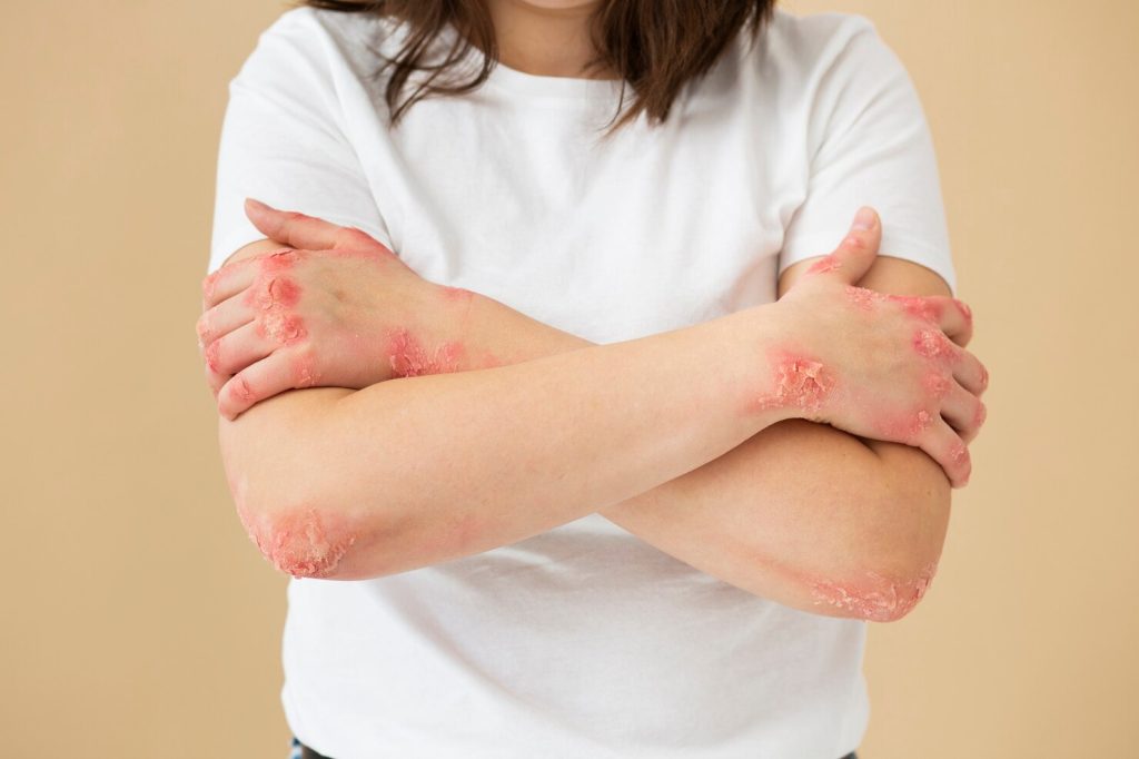 Understanding Eczema